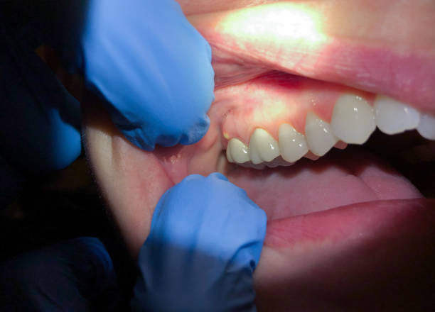 Best Emergency Wisdom Tooth Extraction in Islandia, NY